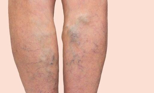 Varices