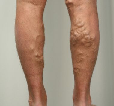 varices