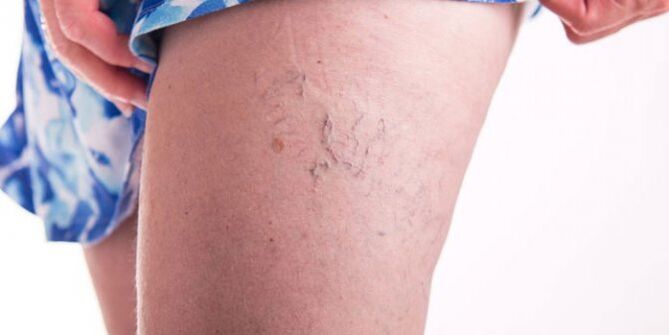 Varices