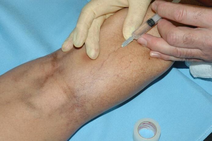 escleroterapia