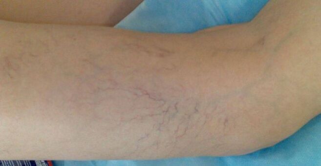 varices