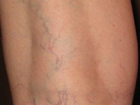 Etapas de las venas varicosas