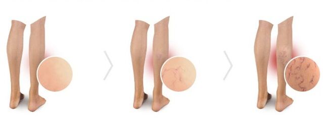 varices