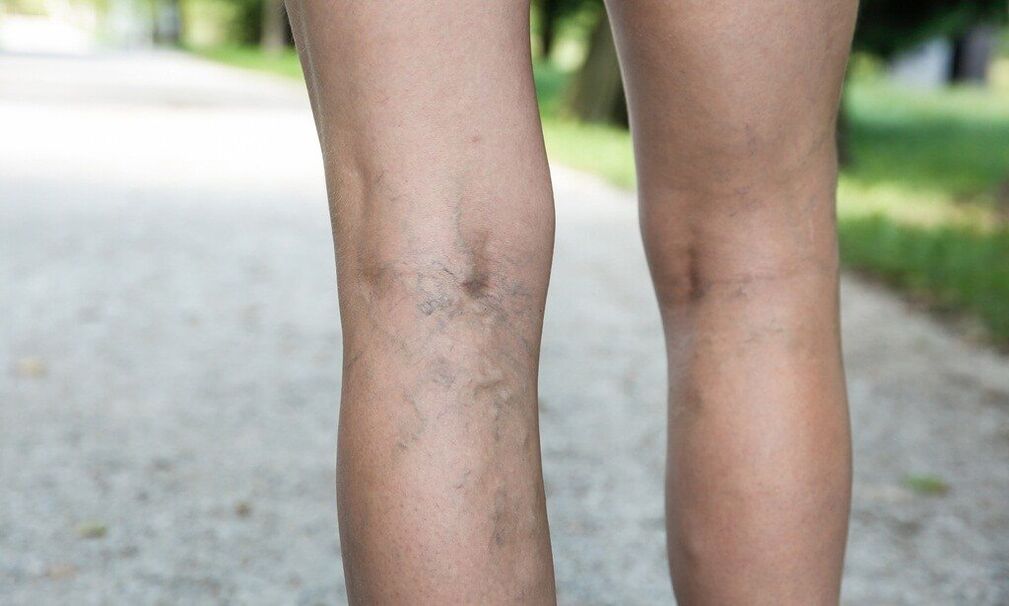 Varices