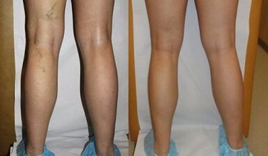 Tratamiento con láser de la foto de las venas varicosas antes y después