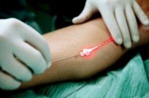 Tratamiento con láser de las venas varicosas en las piernas