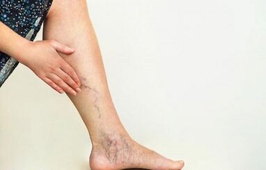 Cómo tratar las venas varicosas de las extremidades inferiores.