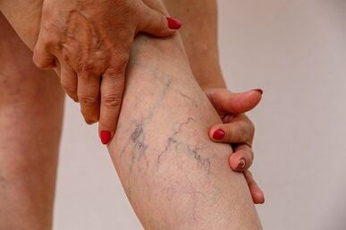 venas varicosas de las extremidades inferiores