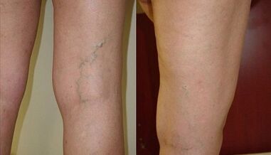 microflebectomía para venas varicosas