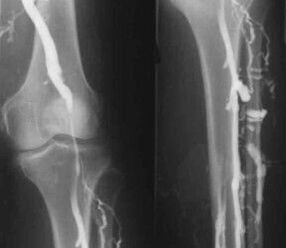 Opciones de diagnóstico para las varices de las extremidades.