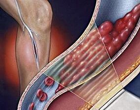 venas varicosas de las venas profundas de las extremidades inferiores