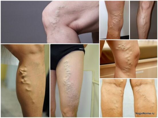 ¿Qué son las venas varicosas