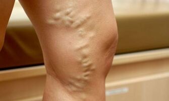 Signos y síntomas de las venas varicosas en las piernas