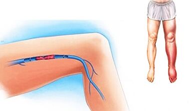 posibles complicaciones de las venas varicosas